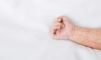 Bé bị dị ứng đạm bò: Nguyên nhân, dấu hiệu và cách cải thiện